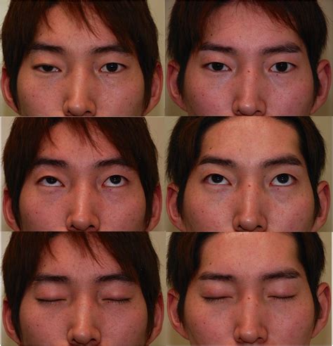 先天性眼瞼下垂症の患者さま - 美容形成外科医Dr 牧野のblog
