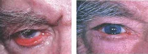 To reduce fat on the cheeks, you need to lose weight. Paralytic Ectropion - Cell Carcinoma - Derick Mussen ...