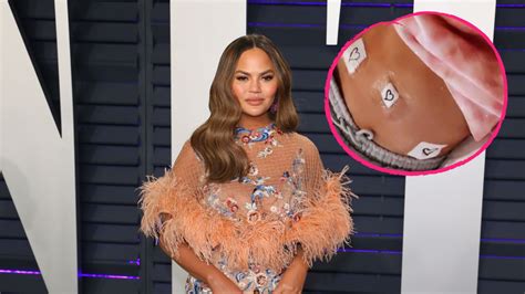 Learn more about the types, symptoms, causes, diagnosis, stages, treatment, and. Nach Fehlgeburt: Chrissy Teigen hat eine Endometriose-OP ...