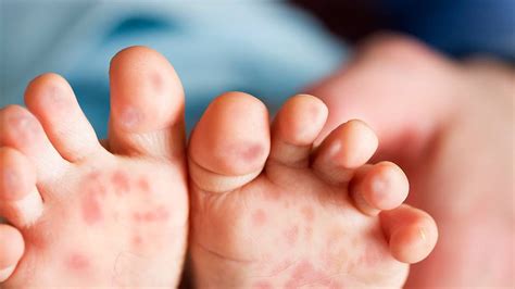 Bagi luka di mulut yang menyebabkan rasa sakit ketika makan, doctor selalunya akan beri gel bonjela untuk mengurangkan rasa sakit. Petua Semulajadi Merawat Penyakit Tangan Kaki Dan Mulut (HFMD)