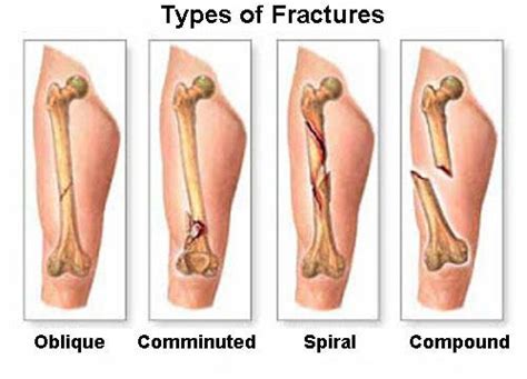 Bone pain is often the first symptom of cancer that however, the only way to confirm whether a cyst or tumor is cancerous is to have it biopsied by your doctor. 5 Primary Bone Cancer Symptoms You Should Know - Step To ...