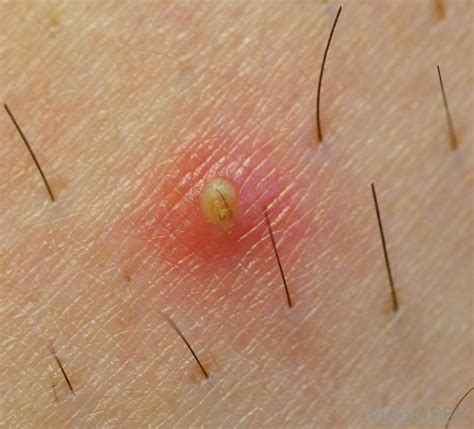 Preventing ingrown hairs is actually counterintuitive—recurring ingrown hair stems from shaving or waxing, she says. How do I Treat an Infected Ingrown Hair? (with pictures)