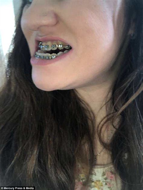 Upper jaw expanders are usually fitted across the top of your mouth and held into position using your upper molars. Holly Everson-Bullock has jaw realigned after underbite ...