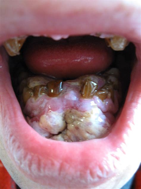 Prices at a general veterinary practice may be much less. oral carcinoma / mouth cancer | massive tumor (squamous ...