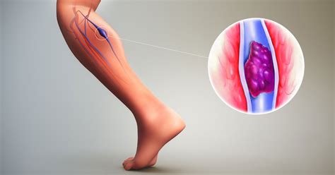 1 op de 4 mensen in nederland overlijdt aan trombose. Trombose - Primeiros sintomas que o corpo dá do problema ...