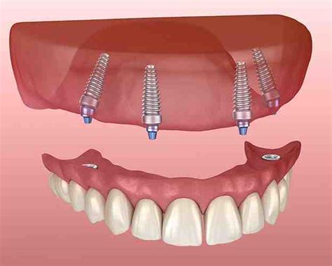 Webmd explains dental implants, which may be an option for people with missing teeth. What Is The Cost Of Dental Implants » Dental News Network