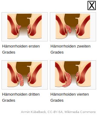 Der facharzt kann rasch herausfinden, ob wirklich eine analthrombose die ursache ist und ob eine medizinische behandlung nötig ist. Zu welchem Arzt geht man mit Hämorrhoiden?