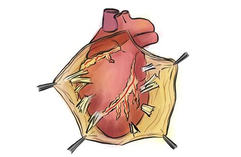 We did not find results for: Pericardial Mesothelioma | Mesothelioma Affecting the Heart