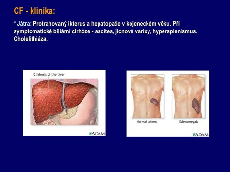 Na vitalion.cz se dočtete, jaké příznaky a zkušenosti mají cystická fibróza je velmi vážné a i přes pokroky medicíny v posledních letech nevyléčitelné onemocnění. PPT - Cystická fibróza (mukoviscidóza) PowerPoint ...