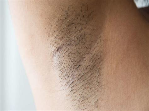 Connect by text or video with a u.s. 56 HQ Images Ingrown Hair Under Armpit With Lump ...