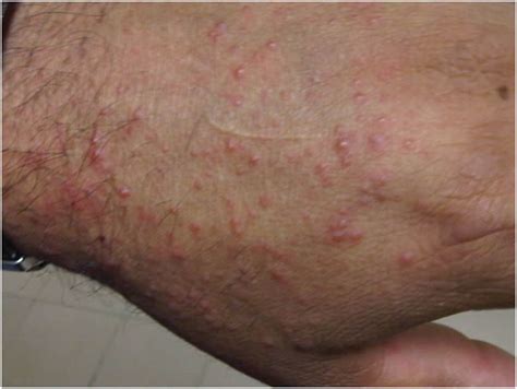 Dermatosis localizada en áreas expuestas caracterizada por ...