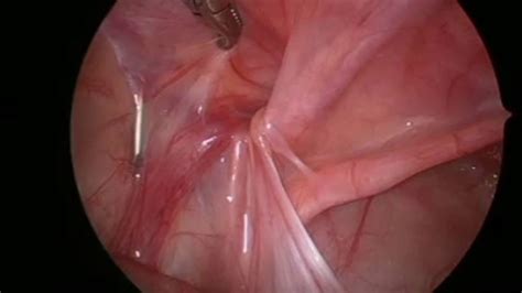 Inguinal hernias can be repaired using surgery to push the bulge back into place and strengthen the weakness in the abdominal wall. Laparoscopic Inguinal Hernia Repair - Boy/Male - International Pediatric Endosurgery Group