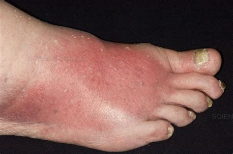 474 racecourse road flemington, vic 3031. Are You Suffering From Cellulitis? - Podiatry HQ