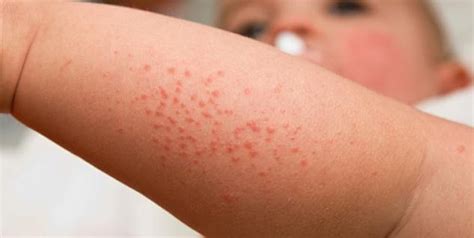 Medications can help reduce your symptoms. herpes on leg - EHEALTH TIPS 4 U