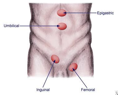 This allows the hernia to be repaired at the same time as the hydrocele. Hernia Surgery Mumbai - Dr Jaydeep Palep