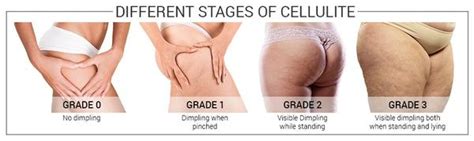 It's hormones, like estrogen, that play a role in the development of cellulite, which may be why cellulite often worsens during pregnancy, says dr. What Is Cellulite? - Balance Clinic