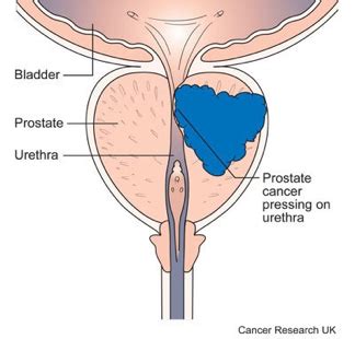 (this is the same for other forms of cancer.) the lymph nodes are a. Prostate cancer symptoms - Marie Keating Foundation