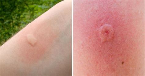 These photos can help you identify different types. Here Are 8 Common Bug Bites And How You Can Recognize Them