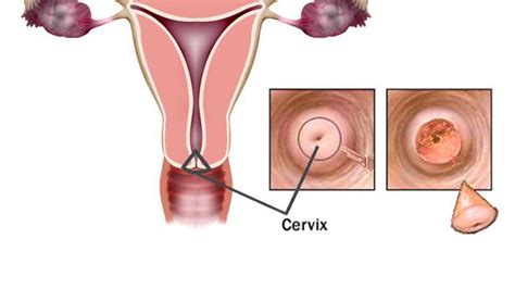 Kanker serviks adalah kanker ganas yang terbentuk di jaringan serviks (organ yang menghubungkan rahim dan vagina). AHLINYA PENGOBATAN WASIR ATAU AMBEIEN: Obat Kanker Serviks ...