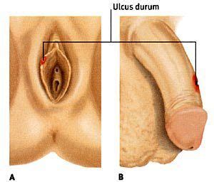 Pickel am eingang der vagina. Dr. Nabielek - Gynäkologie - Infektionen & Dermatosen