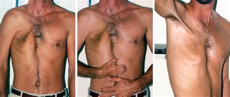 20 poland syndrome is characterized by an underdeveloped or absent chest muscle on poland syndrome is most commonly a sporadic condition (david, 1982; Poland's Syndrome | Thoracic Key