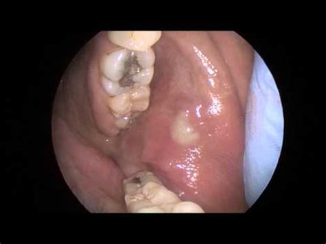 Parotitis is an inflammation of one or both parotid glands, the major salivary glands located on either side of the face, in humans. Akute parotitis, eine akute parotitis wird durch viren ...