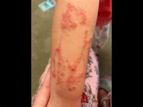 The following skin infections have been reported however, emphasising the need to undergo the procedure in a clean environment using sterile equipment. Three year Old Gets Infection From A Black Henna Tattoo ...