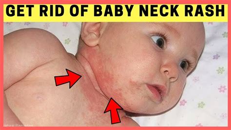 Rinse the affected area of the skin with cold water after about an hour. Baby Neck Rash Home Remedies | How To Get Rid of Neck Rash ...