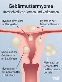 Doch sobald sie beschwerden machen, müssen sie raus foto: Frauenheilkunde: Entfernen von Myomen - Sanft und sicher ...