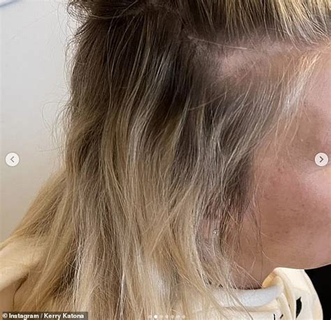 Hair loss is genetic, though the amount of hair fall and its type might differ from your parents. Kerry Katona reveals she's going BALD after years of ...