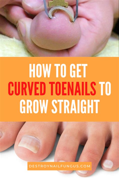 Ingrown toenails tend to jab the skin on the outer edge of the toe. How To Get Toenails To Grow Straight: The Complete Guide ...