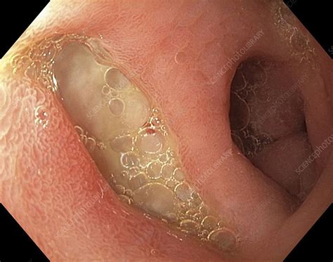 The colon is the final part of the digestive tract. Diverticulitis of the colon, colonoscopy view - Stock ...