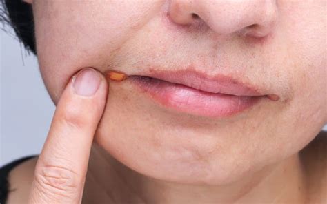 If you have a rash on your lips, it is probably your body reacting to the weather. Rash Around Mouth: 17 Common Causes and Home Remedies