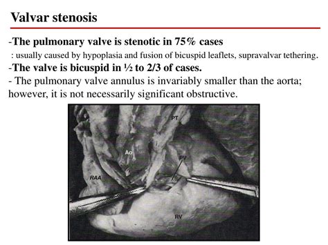 (1) ventricular septal defect, (2) pulmonary stenosis, (3) dextroposition of the ao, and (4) rv hypertrophy. PPT - Anatomy and pathophysiology of tetralogy of Fallot ...