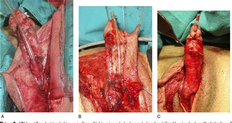 Check spelling or type a new query. Urethral Lengthening in metoidioplasty (female-to-male sex ...