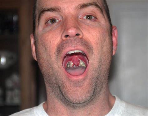 Tonsillitis that is caused by a virus is common for younger children to catch. Pin on tonsils