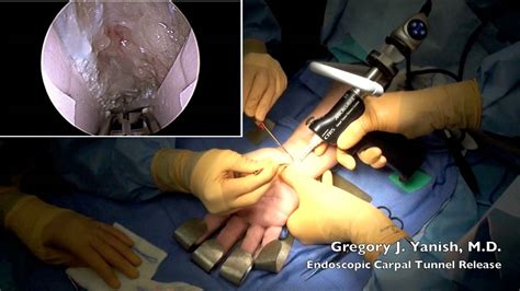 Carpal tunnel syndrome (cts) is an entrapment neuropathy caused by compression of the median nerve as it travels through the wrist's carpal tunnel. Endoscopic Carpal Tunnel Release - YouTube