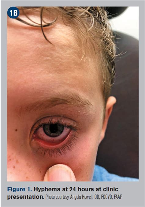 Learn about child abuse symptoms, signs, treatment, and prevention, and read about physical, sexual, emotional, and verbal mistreatment or neglect of children. Accident or child abuse? | Optometry Times