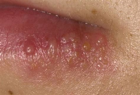 Learn about herpes, a contagious infection caused by herpes simplex virus (hsv). Early Signs & Symptoms of Herpes - Chicken Pox : Overview ...