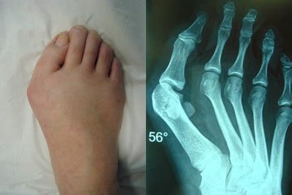 Bunion adalah sebuah gangguan yang progresif. benjolan pada ibu jari kaki | ~ Ma Petite Arie