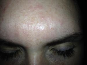 Closed comedones are formed when your hair follicle is trapped with a plug made up of dead. Forehead acne help! | Beautylish