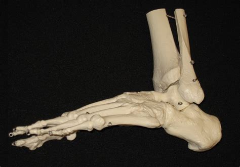 Die inzidenz einer akuten erkrankung beträgt beim diabetiker zwischen 0,15 und 2,5 %. Lisfranc-Arthrodese - OGAM Orthopädie