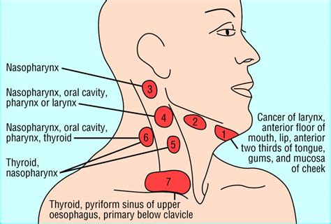 Node chains chest lymph nodes diagram lymph nodes side of neck where are neck lymph nodes located. Management of lateral neck masses in adults | The BMJ