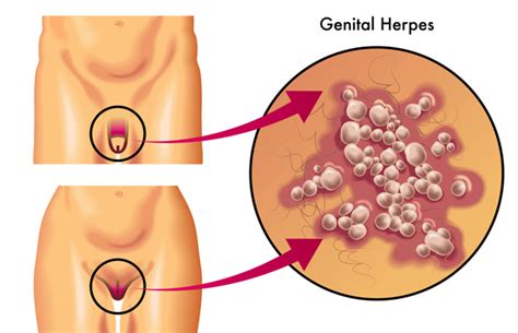 One of the most striking is the appearance of clean linear erosions. Symptoms of Genital Herpes | MedGuidance