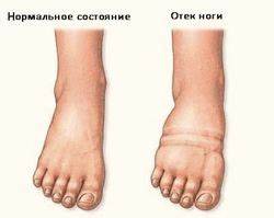 Сердечная недостаточность на диете Что такое сердечные отеки Что такое сердечные отеки Сердечная недостаточность на диете