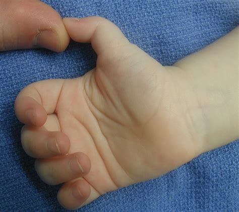 Atrofia de los abductores del pulgar. Pulgar flexionado: Tenovaginitis Estenosante del Pulgar o ...