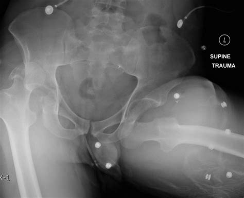 This page shows the treatment of a poodle mix that fell while running, and is now completely lame on its rear leg. Bilateral Hip Dislocation in Unrestrained Driver - JETem