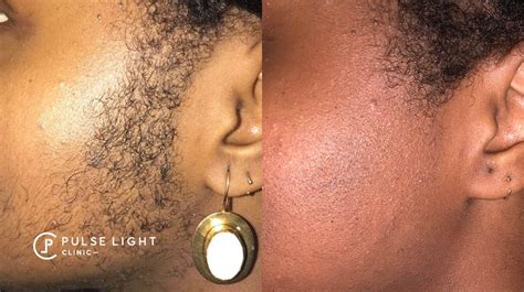 During hair removal application, the light pulses are aimed at strategic points in the skin to neutralize the natural growth cycle of hair. Laser Hair Removal London | Pulse Light Clinic London