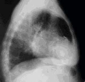 Modificazioni sequenziali (4 stadi) della ripolarizzazione ventricolare che riflettono la sofferenza degli strati subepicardici del miocardio. PERICARDITE ACUTE SI CRONICE - Cauze de afectare pericardica