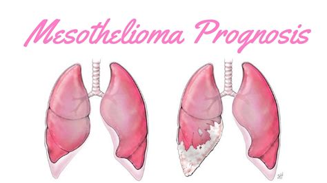 This cancer forms in tissue that covers. Mesothelioma Prognosis - YouTube